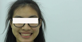 Chữa cười hở nướu