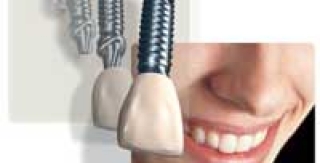 Cấy Ghép Răng Có Răng Giả Trễ 