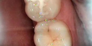 Liệu các chất trám bít hố rãnh(sealants) có hiệu quả thật sự ?