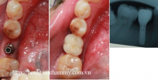 Cấy ghép răng implant 5
