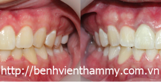 Răng sứ Emax Zircad - Ivoclar Vivadent - Thụy Sỹ 21