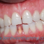 Răng sứ Ivoclar vivadent 10