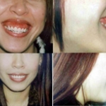 Điều trị cười hở lợi