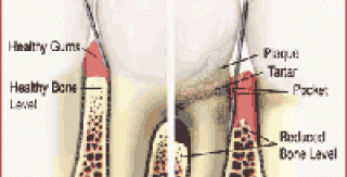 Bệnh nha chu (periodontal disease) 