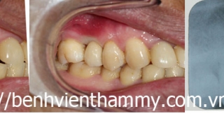 Cấy ghép răng implant 7
