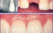 Biện pháp vệ sinh răng miệng cho bệnh nhân mang implant