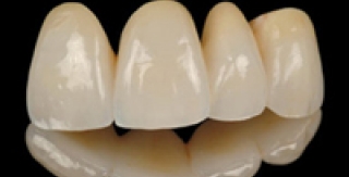 Toàn sứ ZIRCONIUM (CERCON, E.MAX ZIR CAD) - Chuẩn mực mới trong phục hình nha khoa!