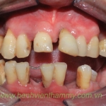 Phục hình toàn hàm 4