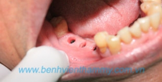 Phục hình trên Implant