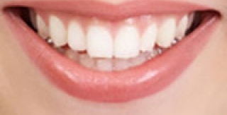 Chứng viêm tủy răng