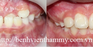 Chỉnh hình răng can thiệp sớm cắn ngược răng trước 2