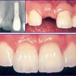 Cấy Ghép Implant Có Răng Giả Sớm 