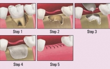 Nhổ răng bảo tồn xương ổ răng. 