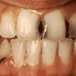 Nếu răng đã bị sâu thì phải làm thế nào? Răng sữa sâu cần phải trám không vì sẽ có răng vĩnh viễn sẽ mọc lên thay thế. Nên chữa hay nhổ? 