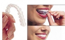 Invisalign - Kỹ thuật chỉnh nha thế hệ mới không mắc cài