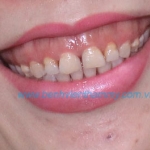 Răng sứ thẩm mỹ 10 răng Emax ZirCad