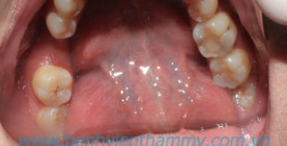 Phục hình implant 3 implant