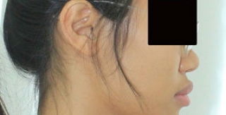 Chỉnh hình răng thẩm mỹ điều trị răng hô với mắc cài  kim loại