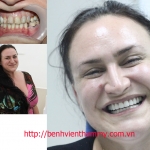 Phục hình răng thẩm mỹ cải thiện nụ cười