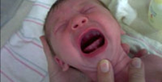 Dính thắng lưỡi ở trẻ em - Những điều cần biết - Phần 3