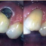 Trám răng thẩm mỹ như thế nào? 