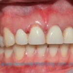 Răng sứ Emax Zircad - Ivoclar Vivadent 8
