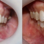 Điều trị răng chen chúc với Răng sứ Veneer thẩm mỹ - kết hợp chỉnh hình răng tiền phục hình