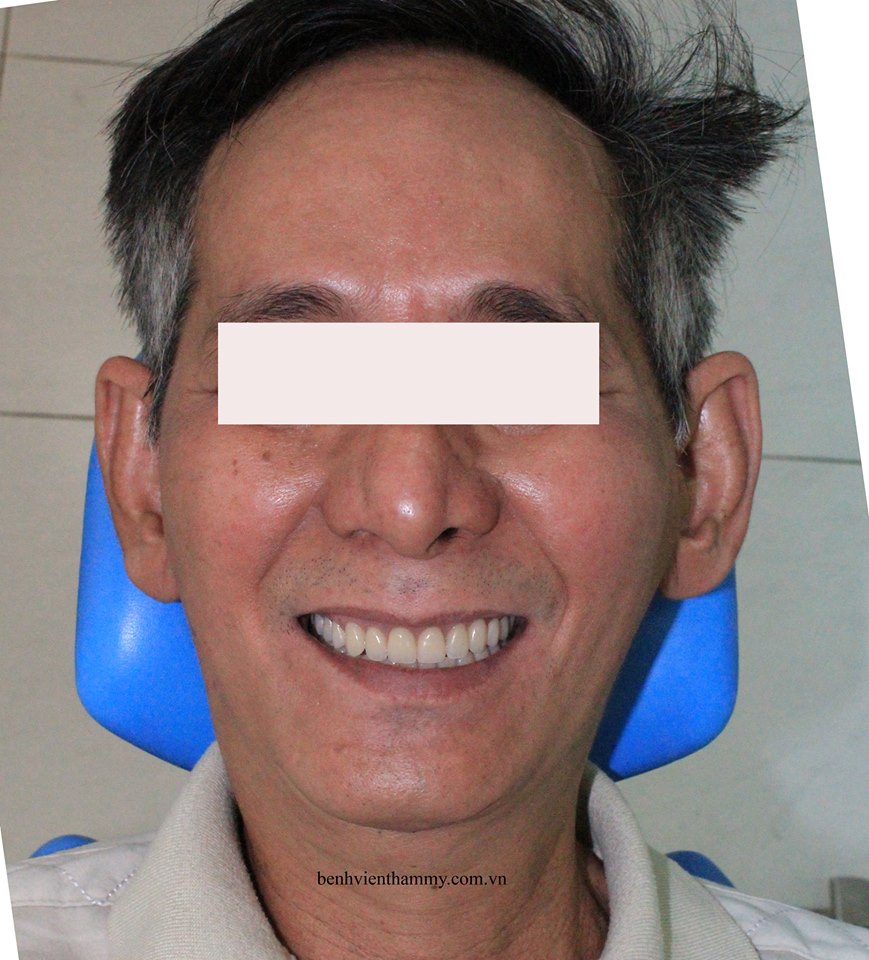 implant toan ham13