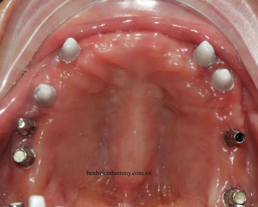 implant toan ham2
