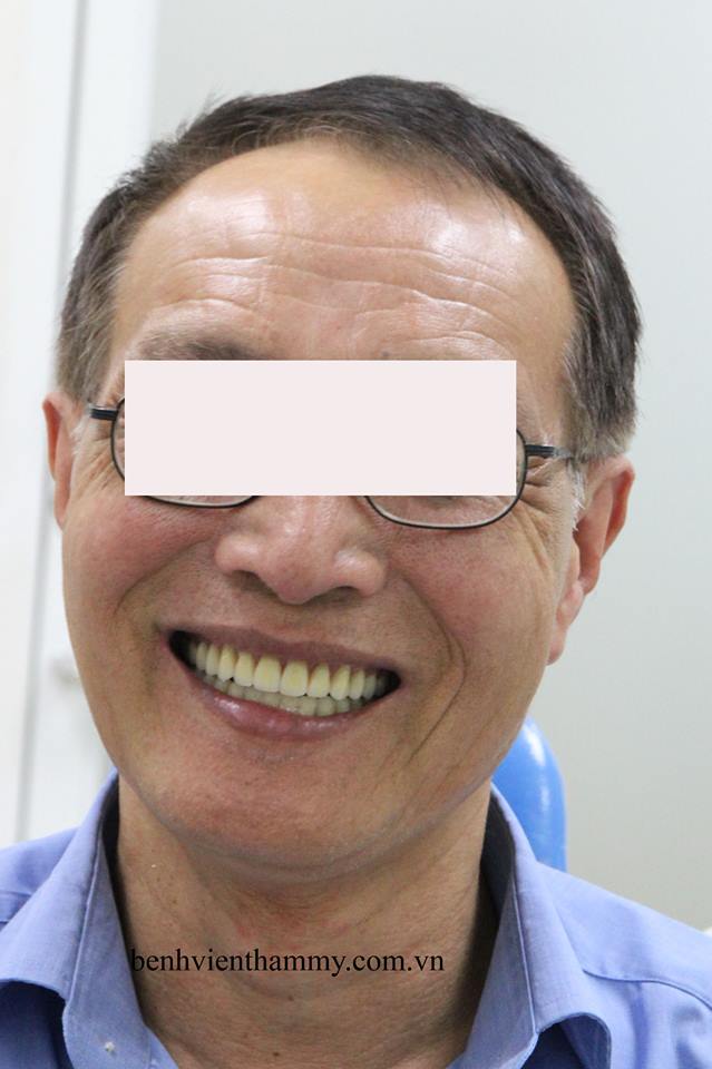 implant toan ham9
