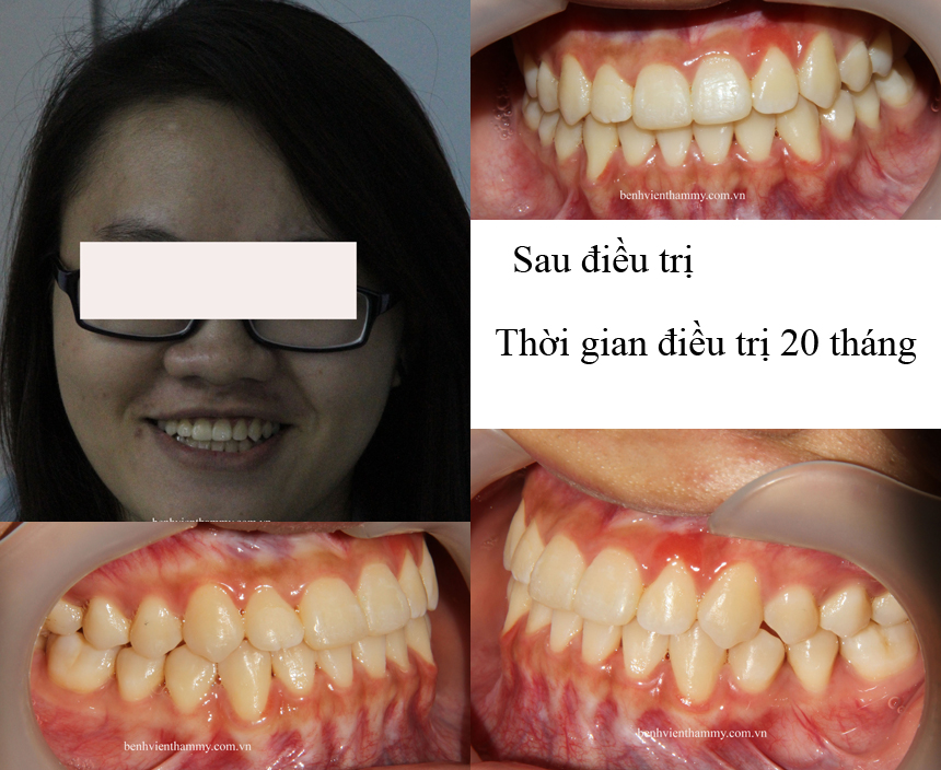 nieng rang ho018