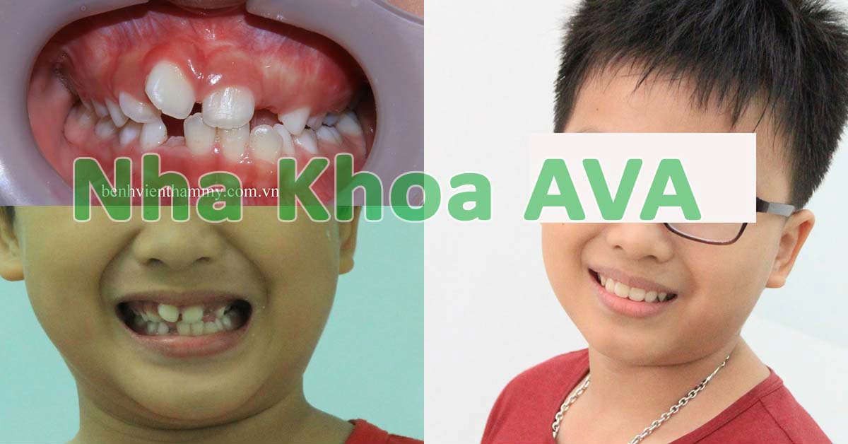hinh anh nieng rang moc lech