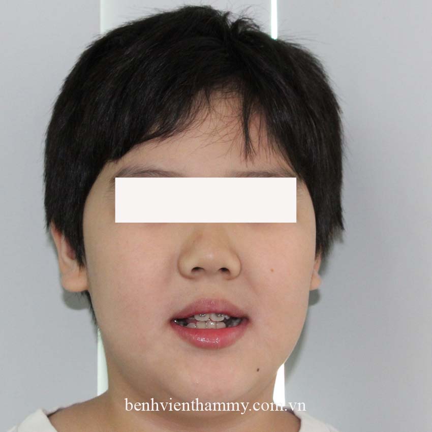 nieng rang chen chuc khong nho rang 1b