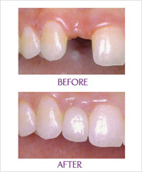 Dental-Implant-C