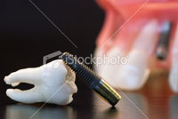 implant-tuc-thi-anh-huong