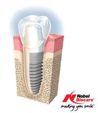 nobe-biocare-ava