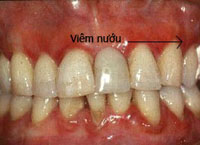 viem-nuou-rang-a1