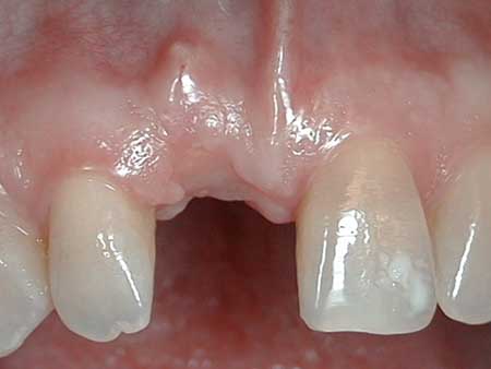 implant21.0