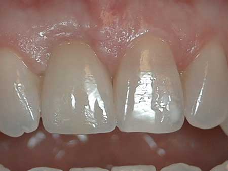 implant21.1