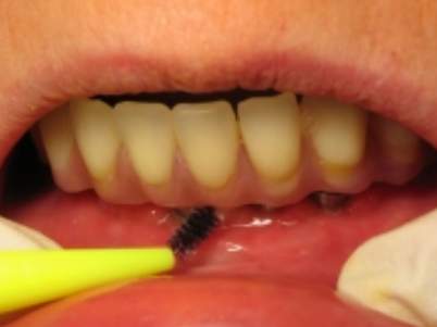 ve-sinh-implant-nha-khoa